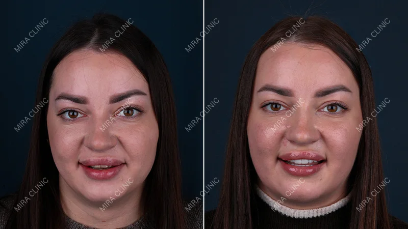 From Italy to Istanbul for a New Smile